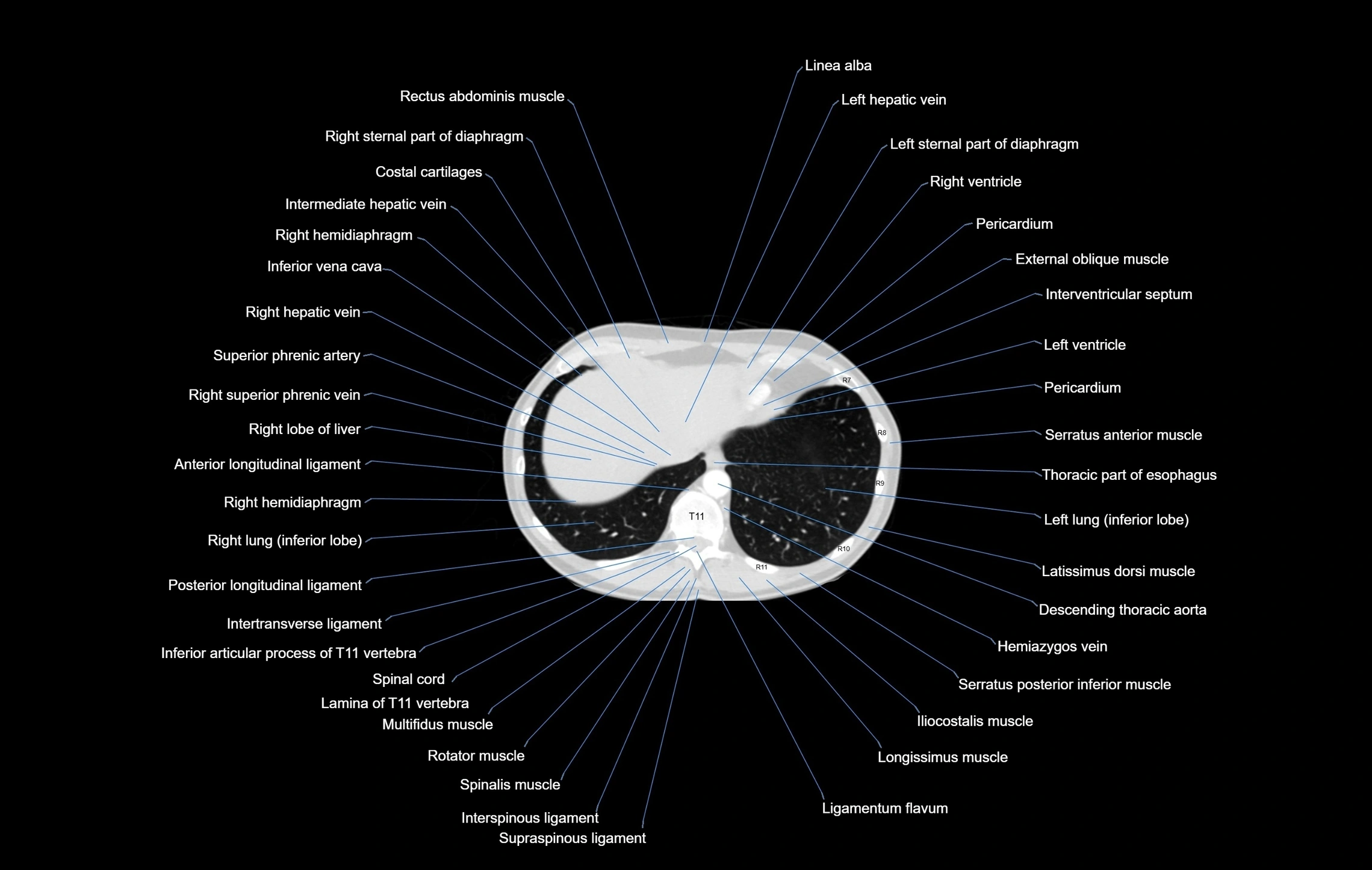 CT chest (thorax) labelled axial cross sectional anatomy radiology image-00101.webp